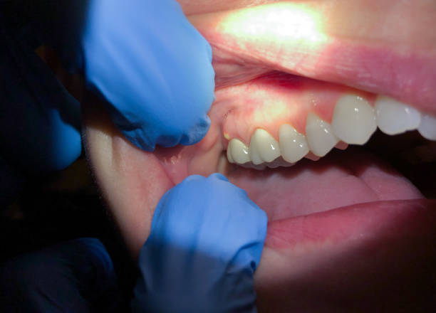 Best Emergency Dental Care for Broken or Chipped Teeth in Collinsburg, PA