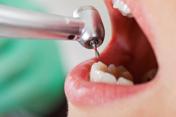 Best Emergency Wisdom Teeth Removal in Collinsburg, PA